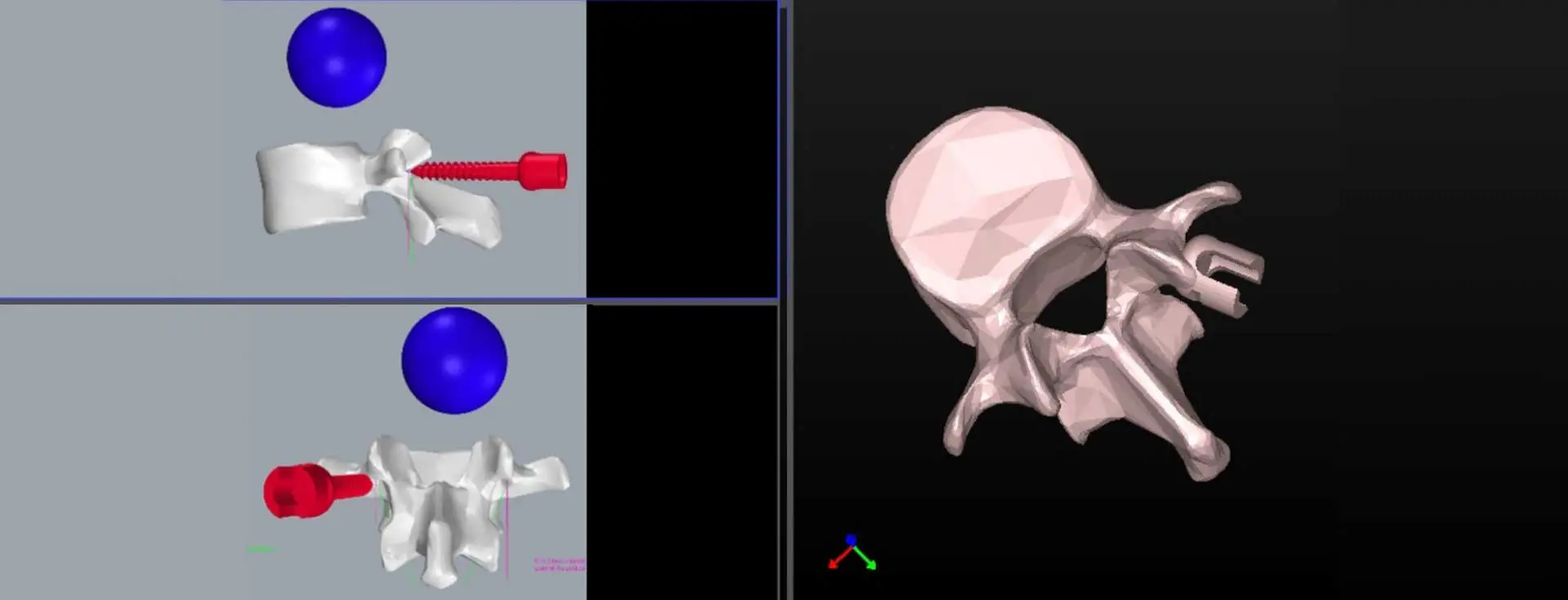 simulation-mode-software-tool-for-bone-implant-visualization